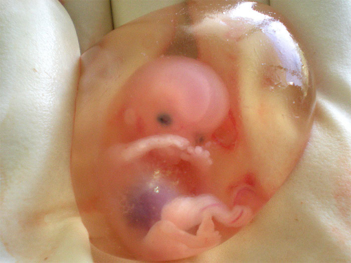abortion at 8 weeks. 8 WEEKS from fertilization