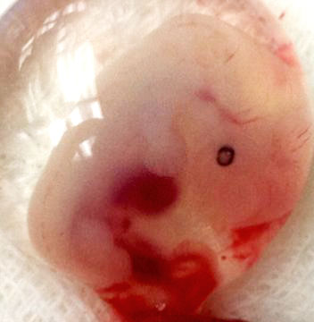 embryos at 5 weeks. 5 week embryo - ectopic