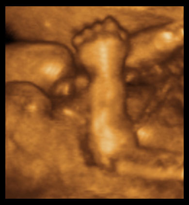24 week fetus